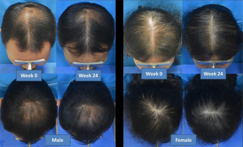 Suchonwanit, P results of androgenetic alopecia treatment with low level laser therapy