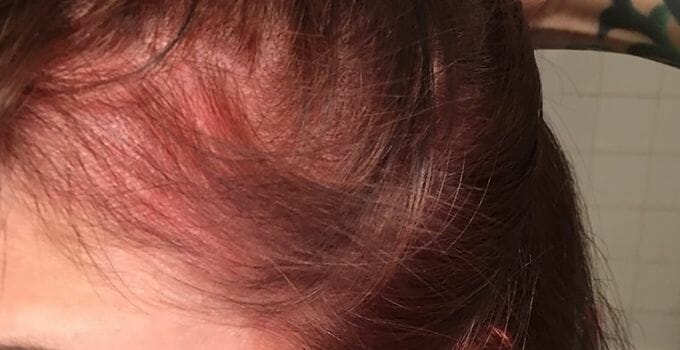 dermarolling scalp side effects redness
