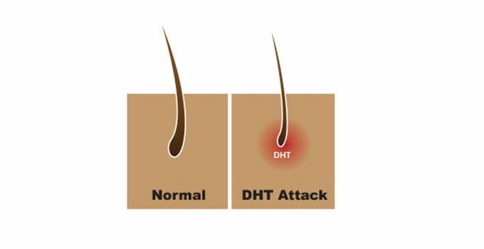 dht effect for hair follicle