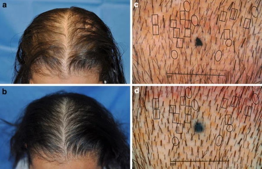 jj jimenenez et al. clinical trial results for laser hair growth