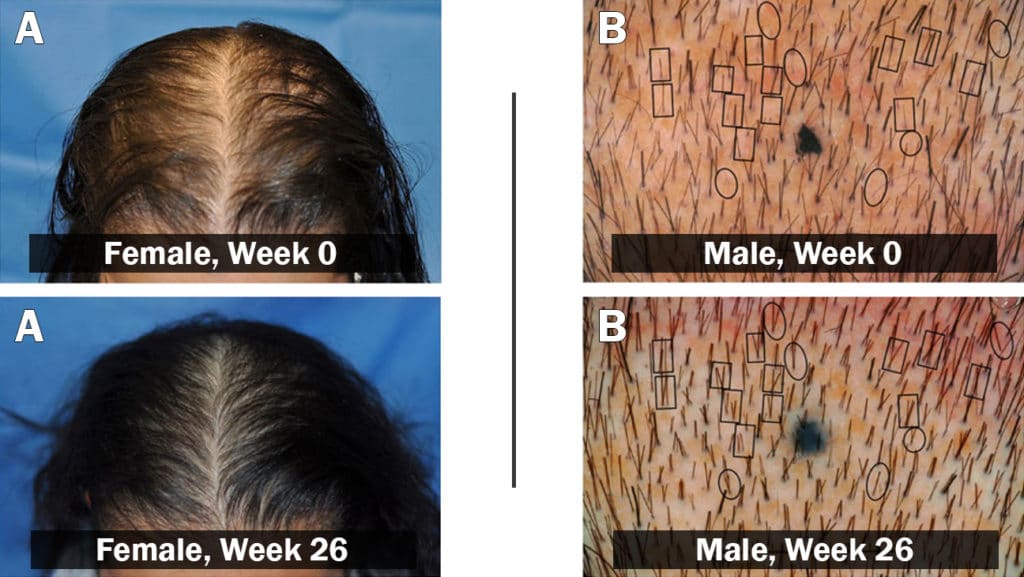 lasercomb hair loss treatment results for female and male