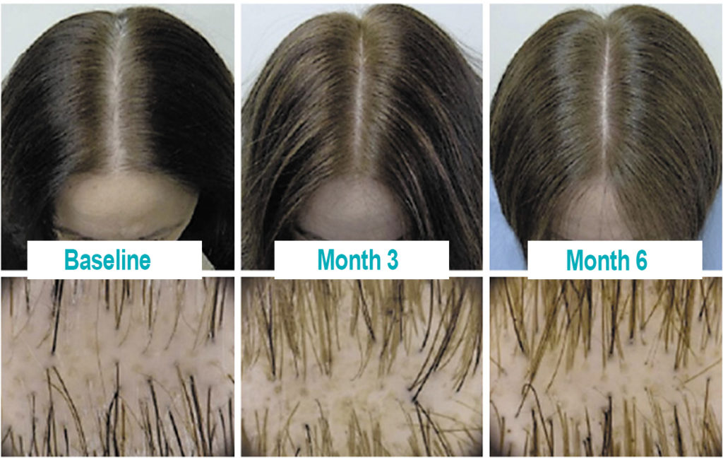 nanoxidil before after for female with hair loss