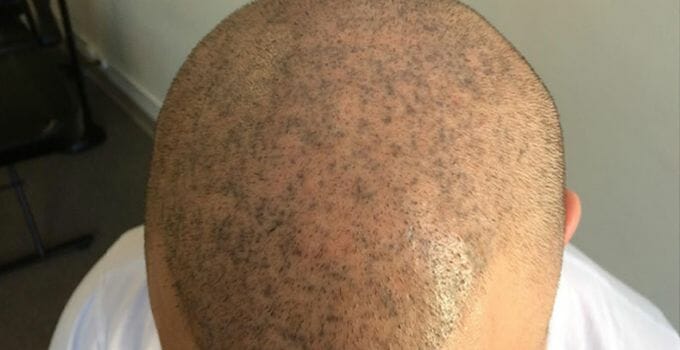 mans scalp with micropigmentation failed results