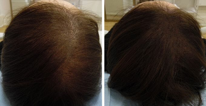 scalp micropigmentation for women results