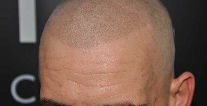 mans head micropigmented