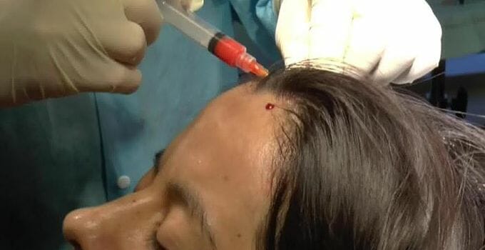 stem cell injection into scalp