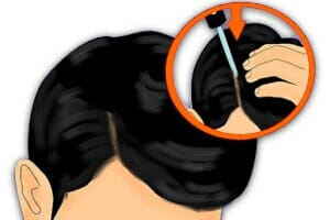 man using dropper to apply hair loss solution