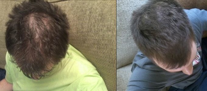 r58841 hair regrowth before after