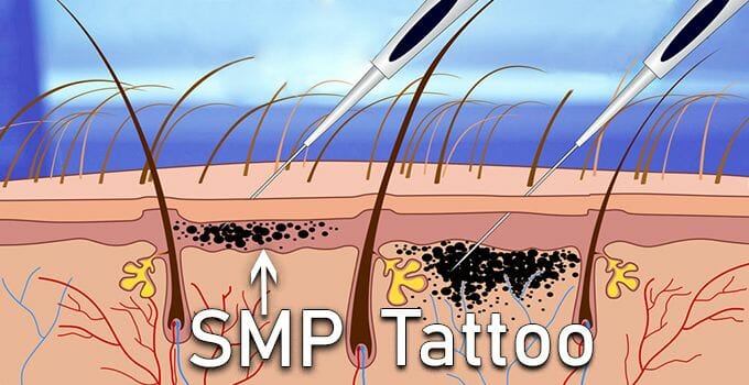 scalp micropigmentation and tattoo ink injection into scalp
