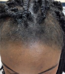 Marginal traction alopecia in woman with braids