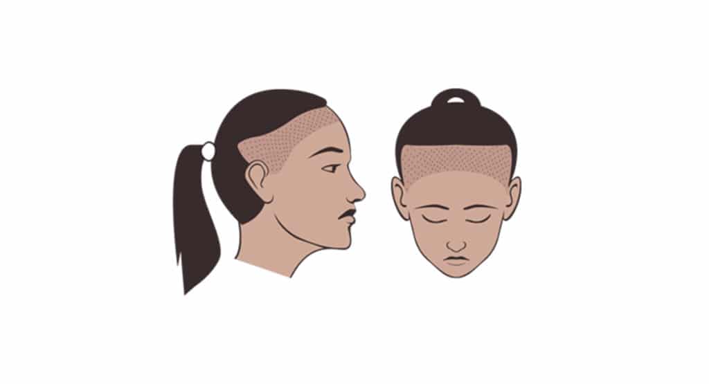 illustration of traction alopecia of woman hair
