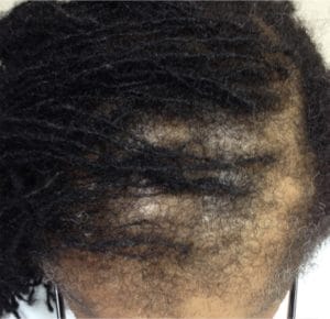 traction alopecia in frontal and parietal scalp