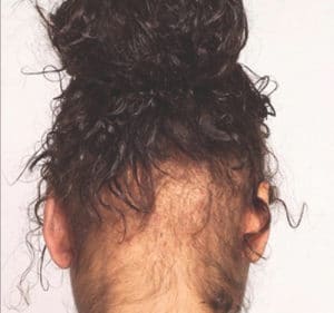 woman posterior hairline traction alopecia