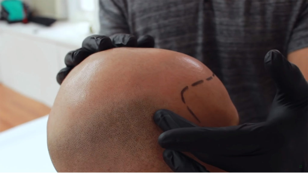 scalp micropigmentation for bald man
