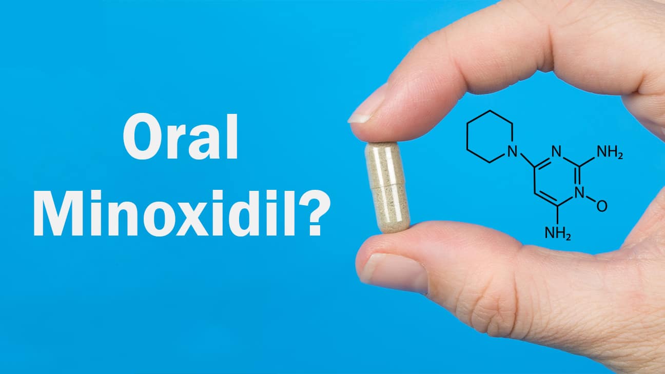 Oral Minoxidil for Hair Loss: Better than Topical? - Hairverse
