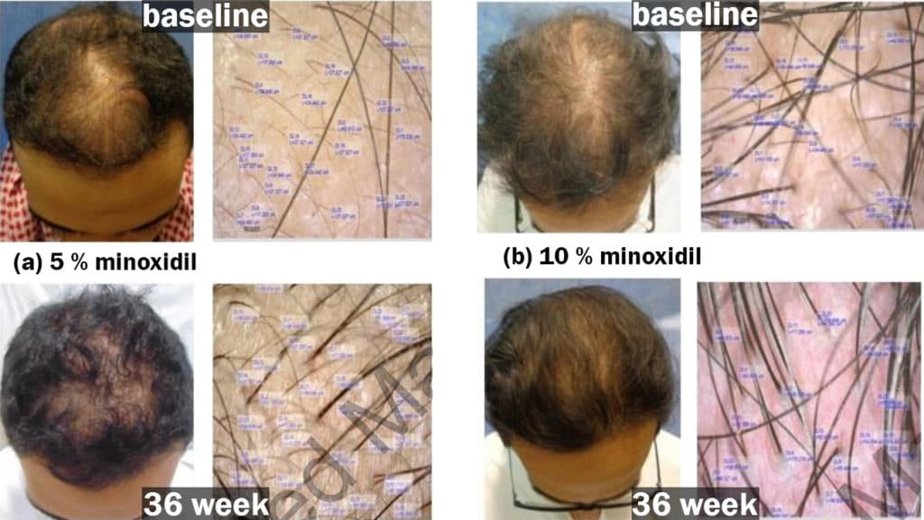5 % minoxidil vs 10 % minoxidil hair loss treatment results