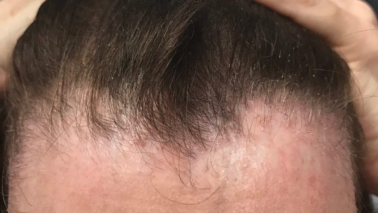 woman with frontal fibrosing alopeci