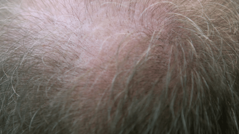 Diffuse Hair Loss: Causes and Treatment