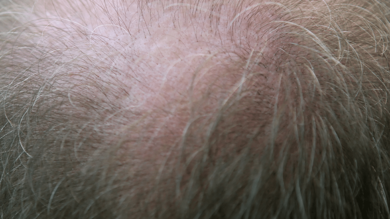 man with diffuse hair loss