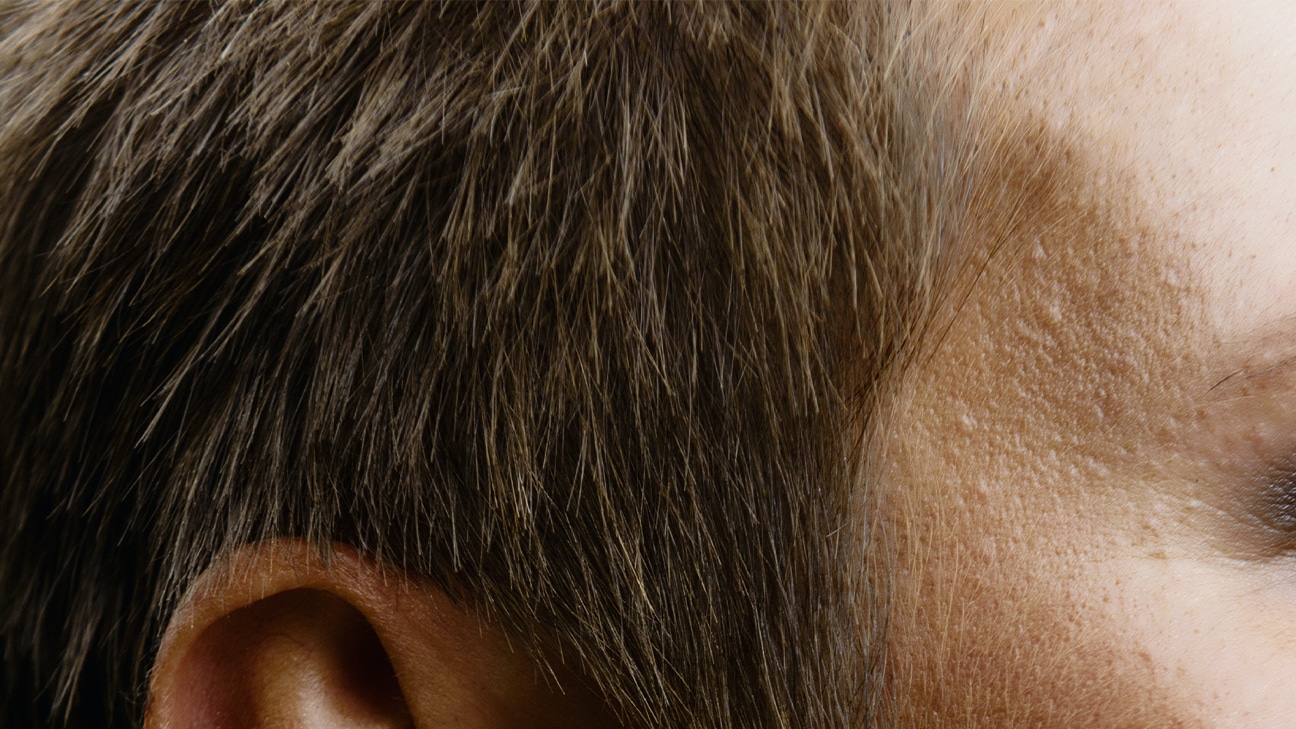 Prostaglandins for Hair Growth: A Potential Hair Loss Treatment? - Hairverse