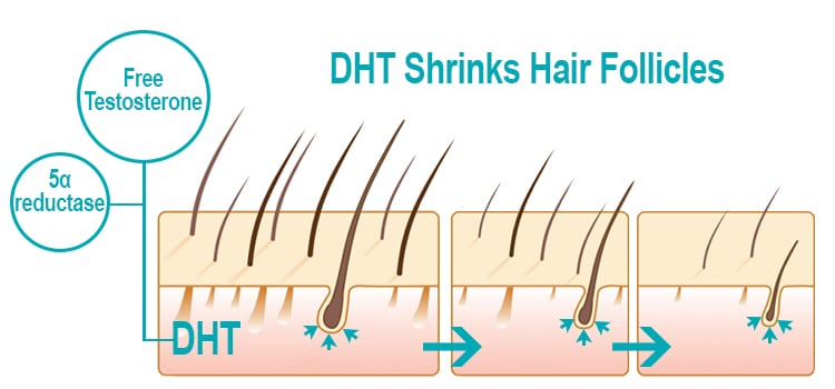 how DHT affects hair follicles