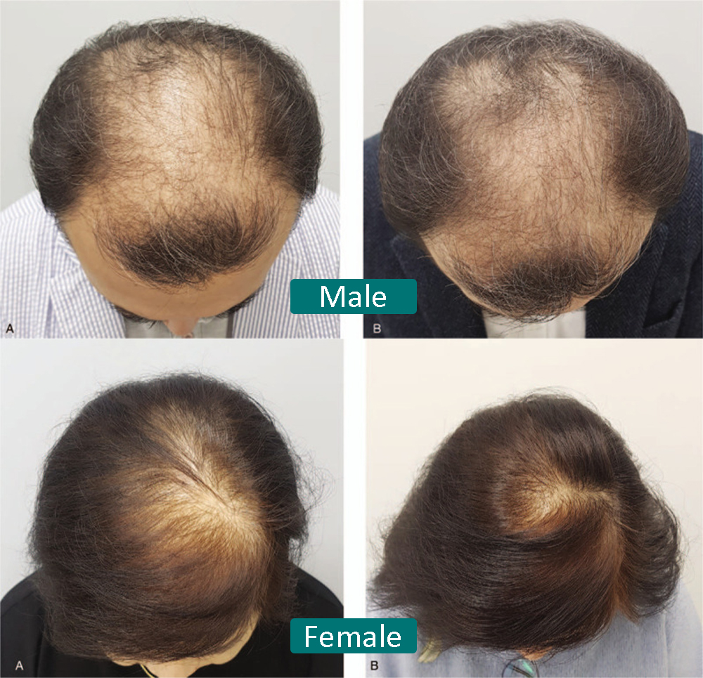 Results of low level laser therapy for female and male anrogenetic alopecia after 16 weeks